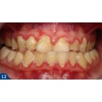 Отзывы людей о Ультразвуковая зубная щетка