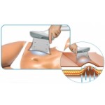 Отзывы людей о Криолиполиз