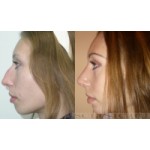 Отзывы людей о Пластика носа