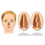 Отзывы людей о Септопластика