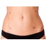 Отзывы людей о Липосакция