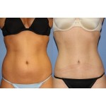 Отзывы людей о Абдоминопластика